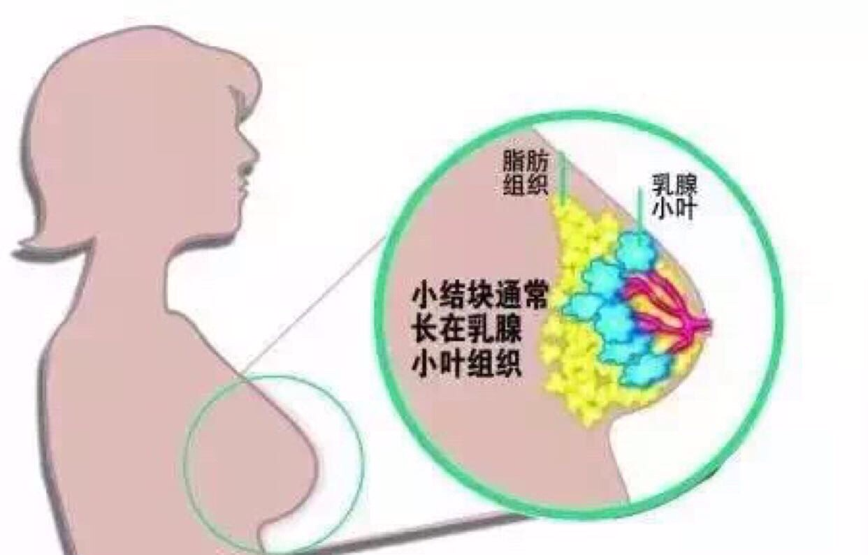 女子陪妹妹复查乳腺，自己也查出癌症_详细说明和解释