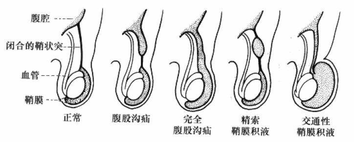 肿瘤病人腹腔积液怎么办_最佳精选落实