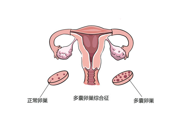 多囊不仅仅是一种妇科病_精密解答落实