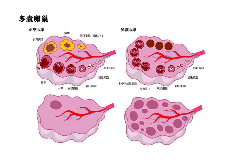 多囊不仅仅是妇科病_效率解答解释落实