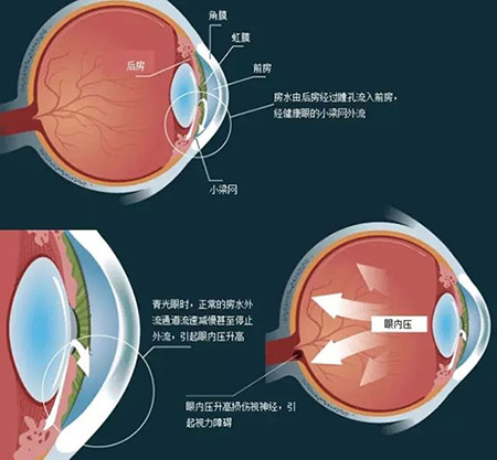 三种情况小心青光眼，预防胜于治疗_精密解答落实