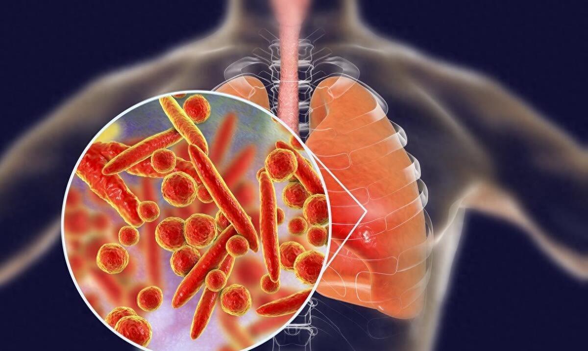 流感合并肺炎症状，深度解析与防治策略_全新精选解释落实