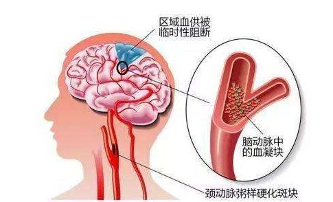 脑梗发作前兆，身体三个部位可能变硬及防治策略_效率解答解释落实