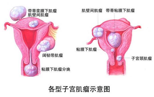 逆境中的希望，一位女性与子宫肌瘤的斗争——39岁长36枚子宫肌瘤_反馈目标和标准