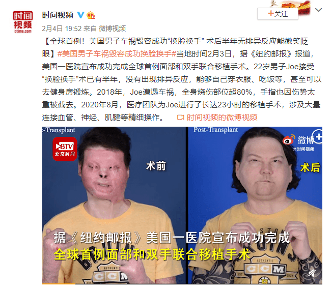 全球首例同时换脸换手男子结婚，奇迹的诞生与爱的力量_解释定义