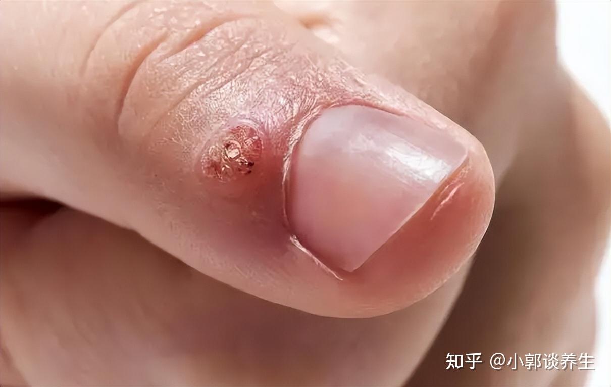 8岁男孩泡温泉，手指疑似感染HPV！这一隐患怎么会发生？_精选解释落实