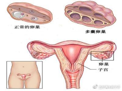 震惊！打工人简历惊现多囊不能怀孕，背后真相令人心酸！_精准落实